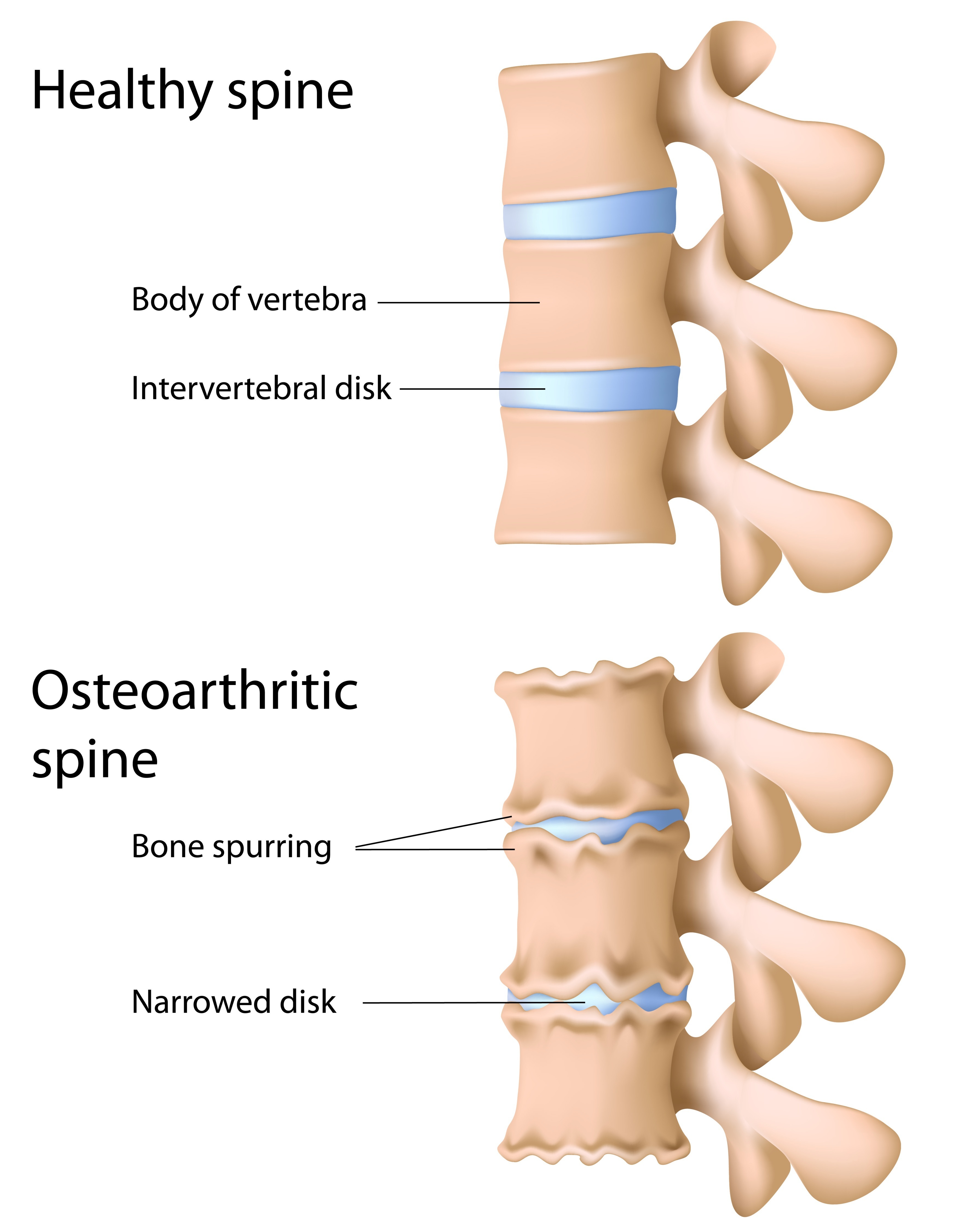 Degenerative Disc Disease The Back and Body Clinic Specialist