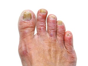 Fungal Infection on foot